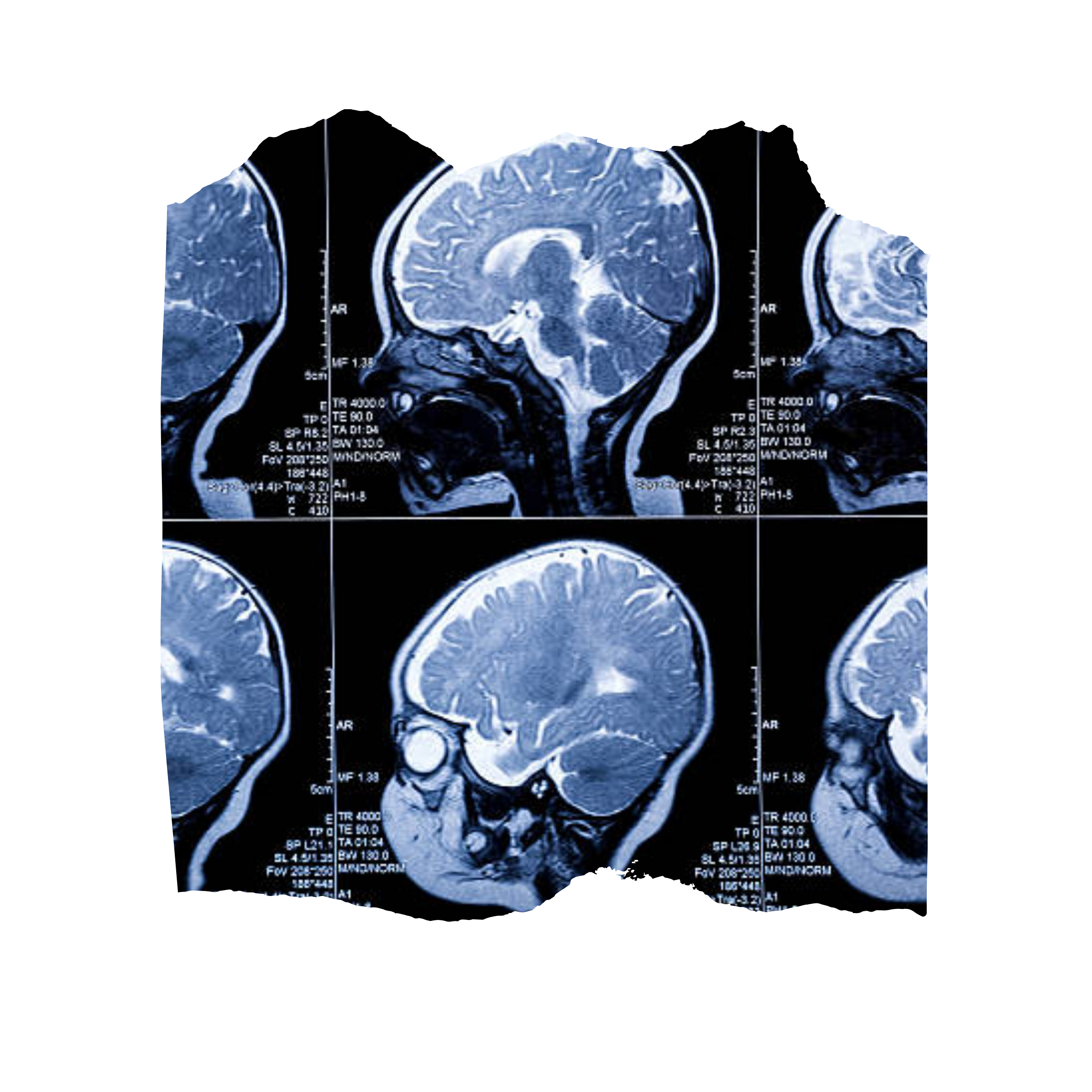 MRI Scan