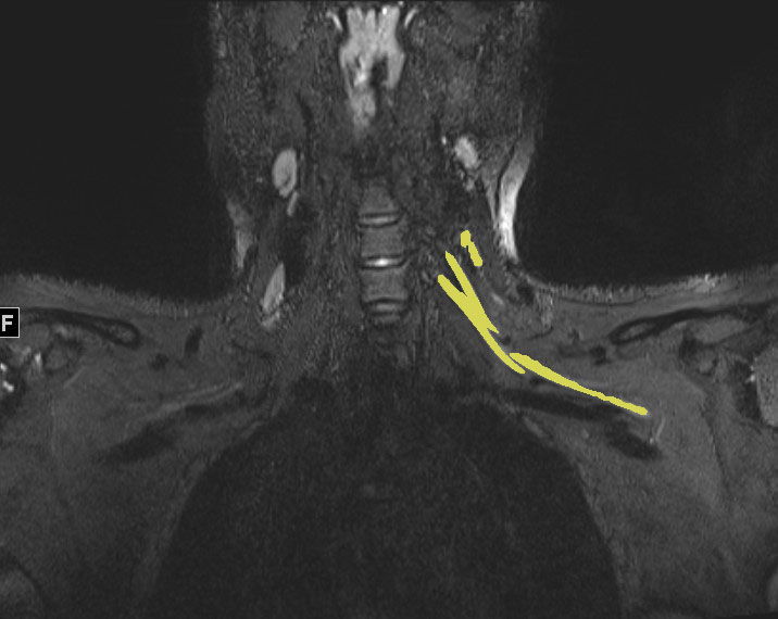 mri nerve damage