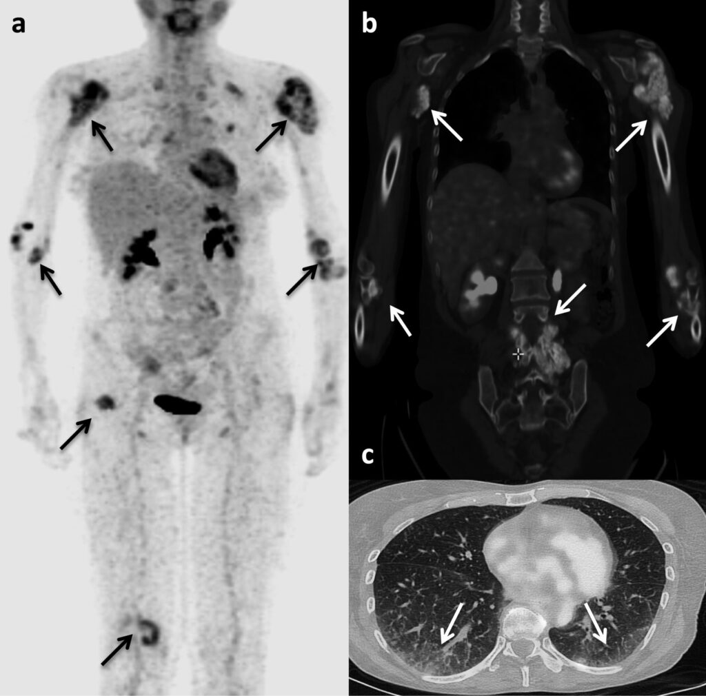 Can diabetes affect my PET scan results? 