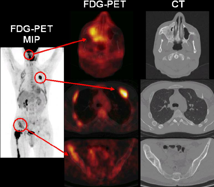fdg pet scan 
