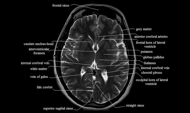 Do I need someone to drive me home after a brain MRI?