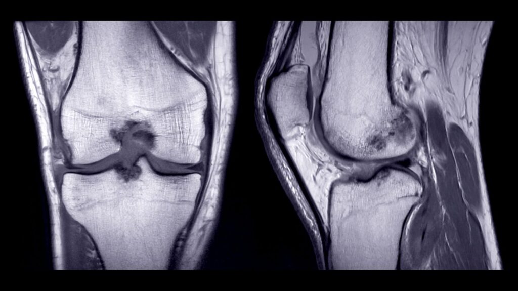 open mri knee